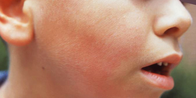 A young boy with red cheeks, showing the "slapped-cheek" rash.