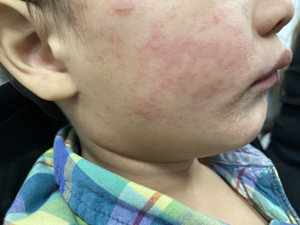 This photograph, taken in the United States depicts a child who was infected with the Morbillivirus, also known as measles, or rubeola during a domestic outbreak in 2024. The child’s cheek shows the characteristic rash associated with this viral infection.